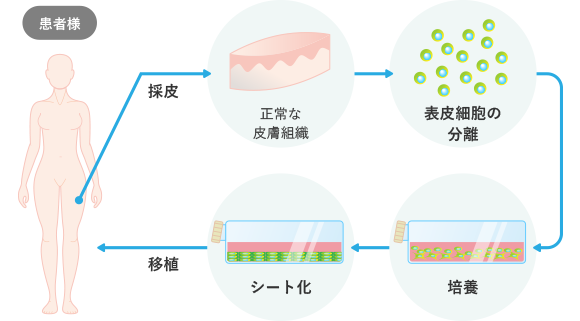 自家培養表皮移植の仕組み