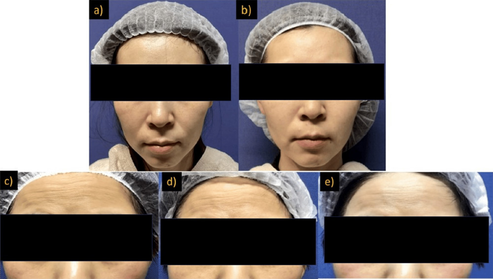 自己培養線維芽細胞を顔に移植した症例写真