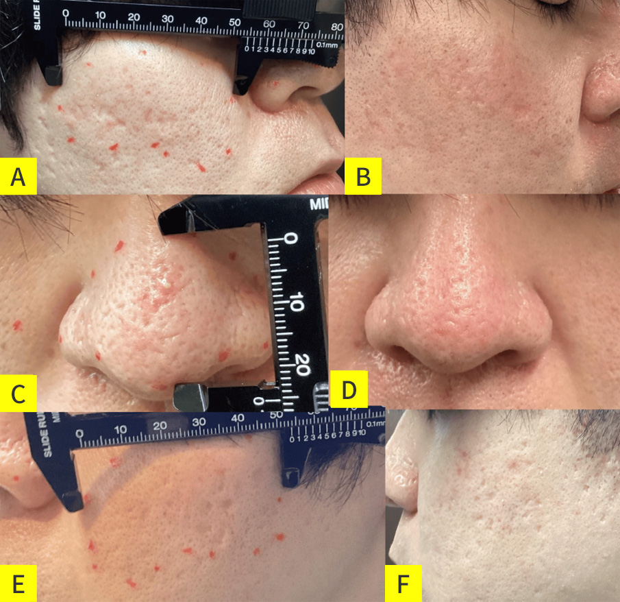 尋常性ざ瘡に伴う瘢痕拘縮