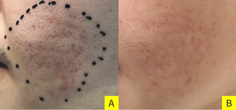 尋常性ざ瘡による瘢痕拘縮