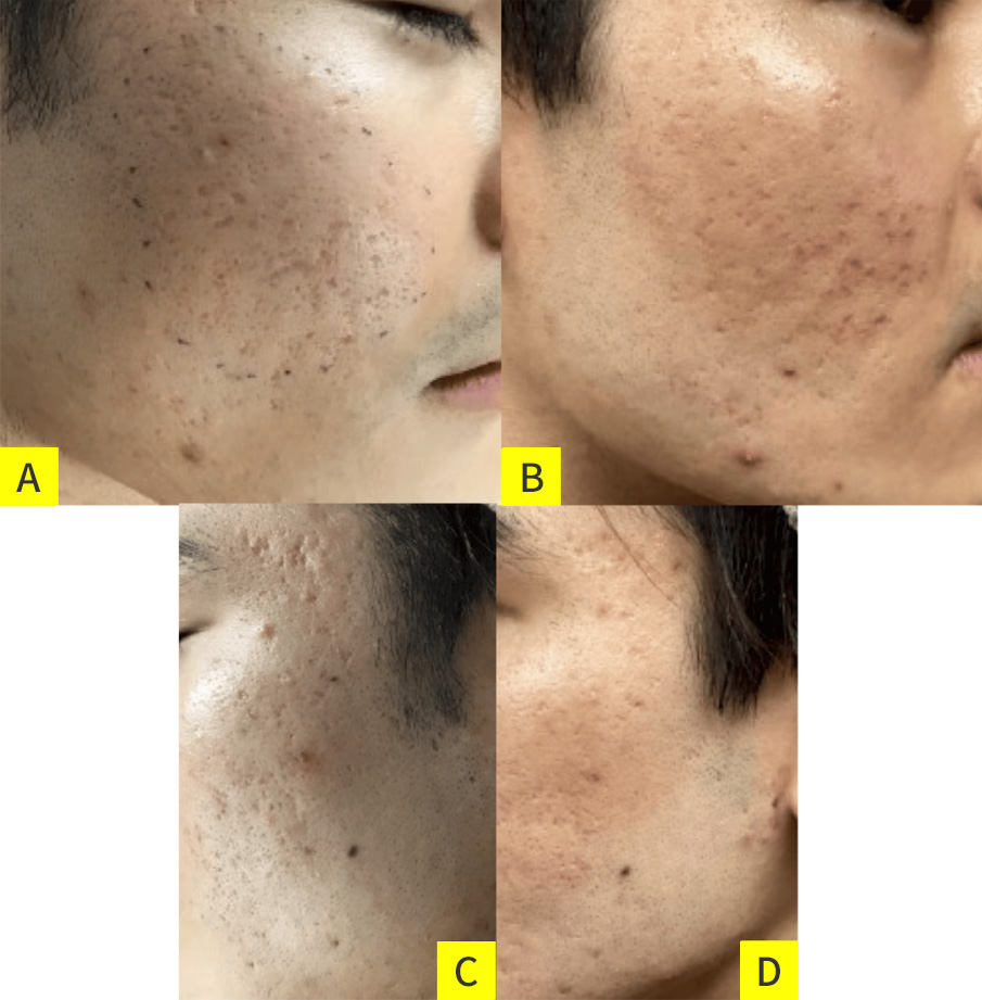 クレーター状瘢痕と拘縮あり