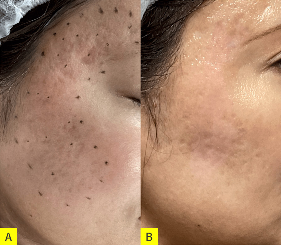 側頭部と頬にクレーター状瘢痕あり