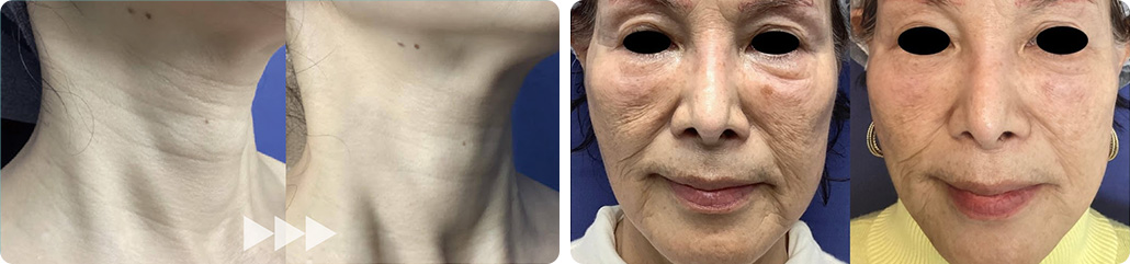 中顔面・下顔面（ちゅうがんめん・かがんめん）の老化集中治療　症例写真
