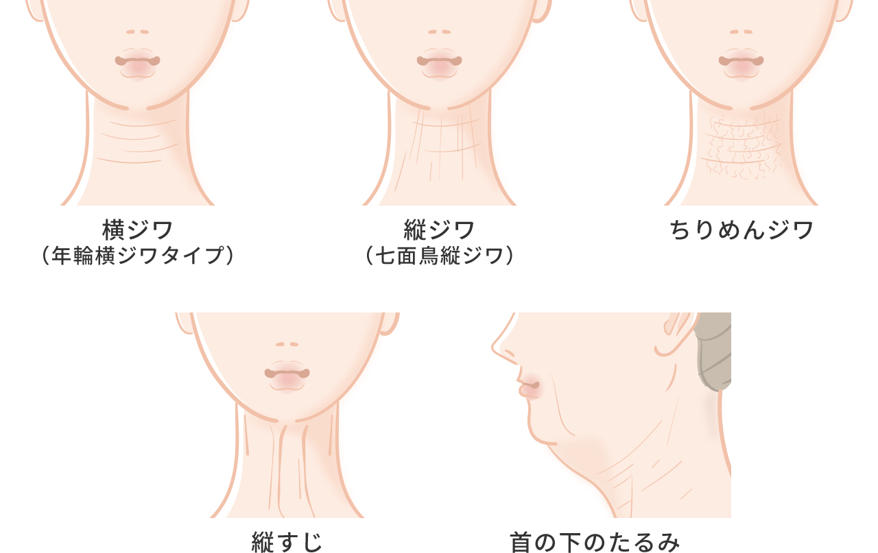 首のシワの種類