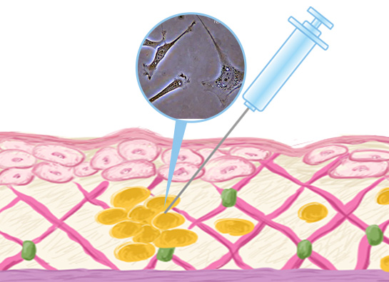 肌の再生医療(線維芽細胞治療)