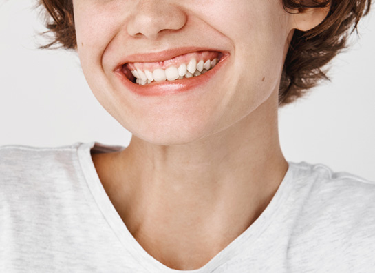 ガミースマイル・口元の改善