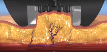 ミニFX施術の流れ1