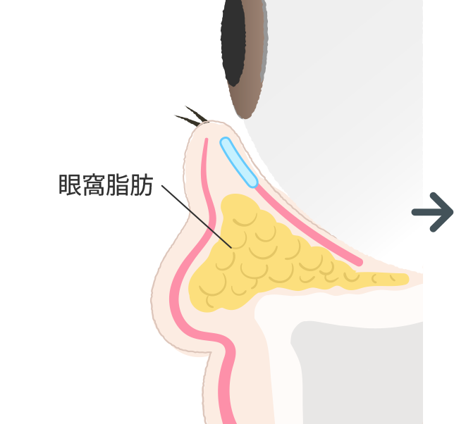 眼窩脂肪の突出と皮膚の緩みで目の下がふくらみ、クマできる