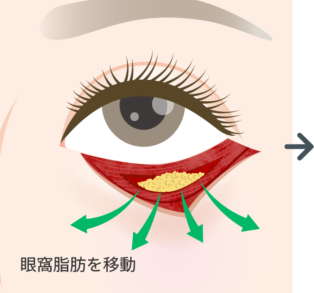 下まぶたを切開し眼窩脂肪を露出させます。必要に応じて余分な皮膚を切除