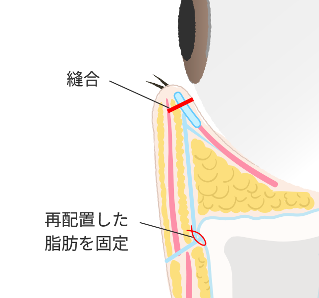 再配置した脂肪を固定し、縫合して手術完了