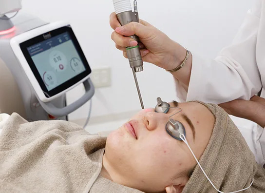 ピコトーニング(色素沈着・軽いニキビ跡)