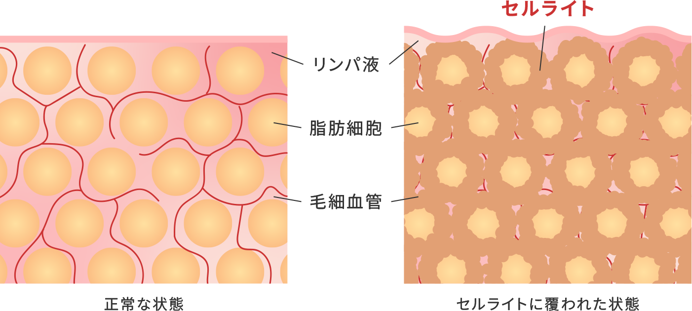 気になるセルライトの集中ケア