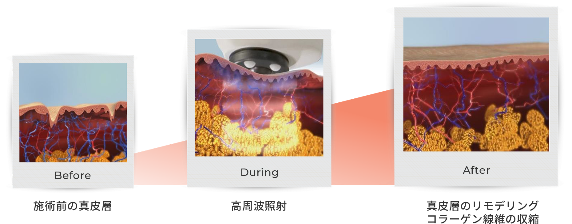 高周波(RF)による皮膚の引き締め