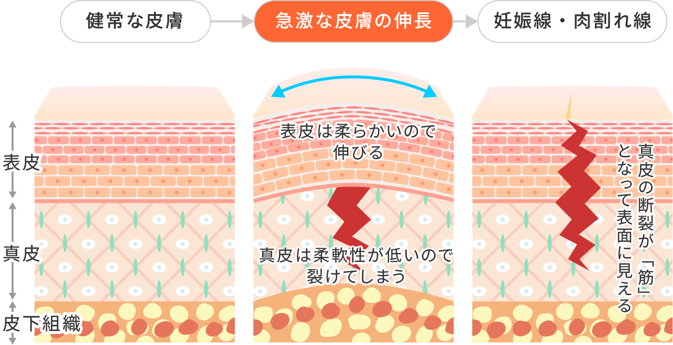 妊娠線(ストレッチマーク)・肉割れの集中ケア