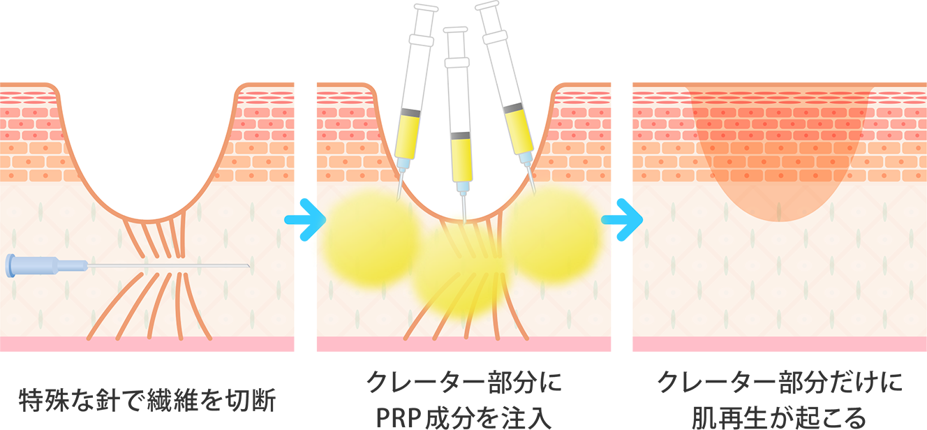 サブシジョンとCPC-PRP&reg;のコンビネーション治療