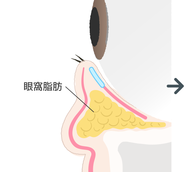 眼窩脂肪の突出と皮膚の緩みで目の下がふくらみ、クマできる