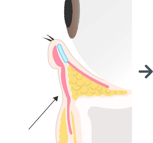 目の下の膨らみが消えても、目の下と頬の境目には溝が残る