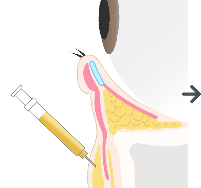 脂肪注入を行い、目の下と頬の境目を埋め、頬上の脂肪を補う。