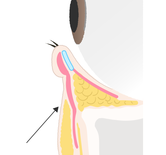 目の下と頬の境目の溝がなくなり、頬上の脂肪の不足も解消される