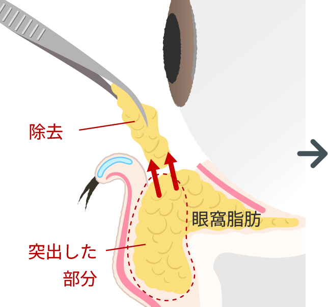 下まぶたを切開し眼窩脂肪を取り除きます。