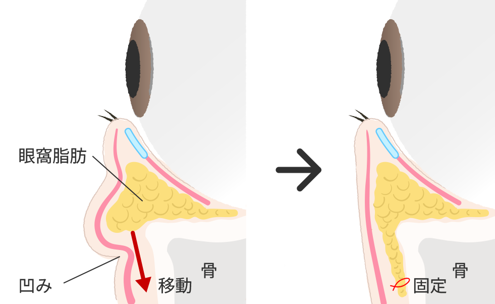 裏ハムラ法（経結膜的眼窩脂肪移動術）施術方法