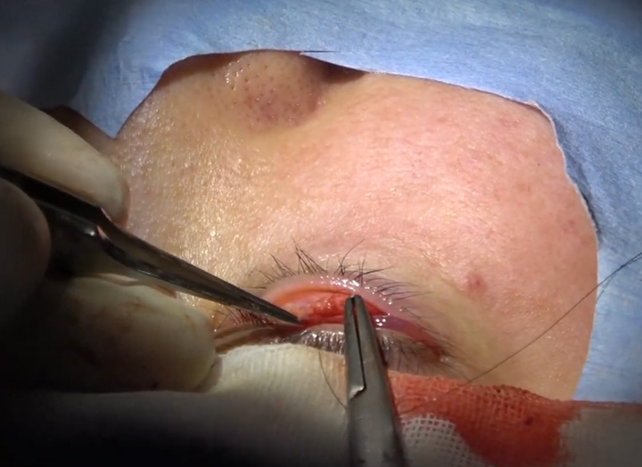 裏ハムラ法（経結膜的眼窩脂肪移動術）の手術