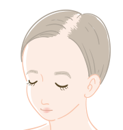 びまん性脱毛症