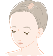 粃糠性（ひこうせい）脱毛症・脂漏性（しろうせい）脱毛症