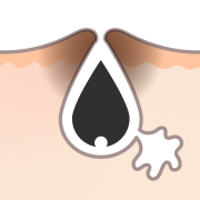 にきび跡：赤味・色素沈着・しみ