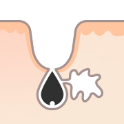 にきび跡：凸凹クレーター状・毛穴の開き