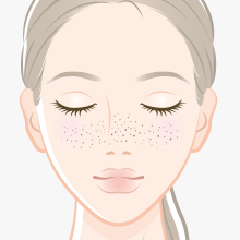 そばかす(雀卵斑)