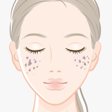 後天性真皮メラノサイトーシス(ADM)