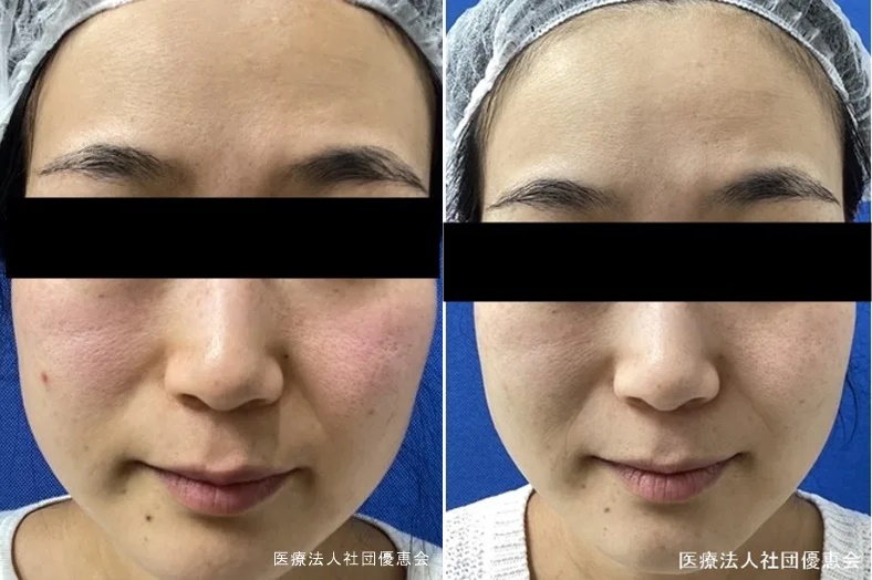 全顔M22+ジェネシス 6回 施術前/施術後