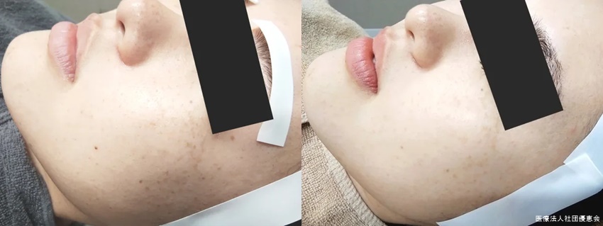 フォトフェイシャルM22+イオン導入 治療前/4回目治療後