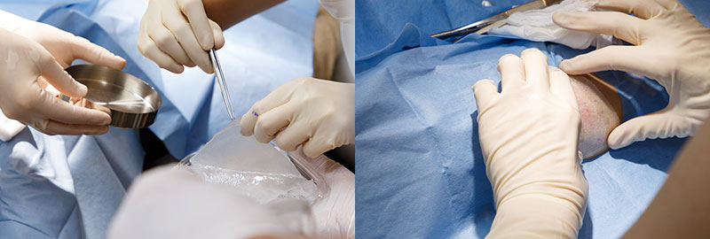 白斑培養表皮移植施術