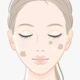 日光黒子(老人性色素斑)