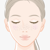 そばかす(雀卵斑)
