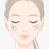 後天性真皮メラノサイトーシス(ADM)