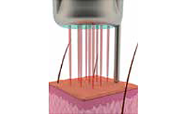 ピコフラクショナル(ニキビ跡、毛穴の開き、小じわの改善)