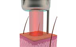 ピコレーザー/シミ取りスポット(シミの改善)