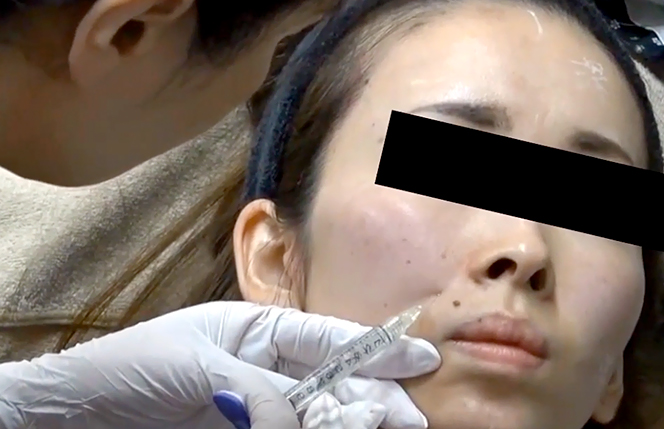 ほうれい線のヒアルロン酸はバレる?バレないためのヒアルロン酸治療のポイント