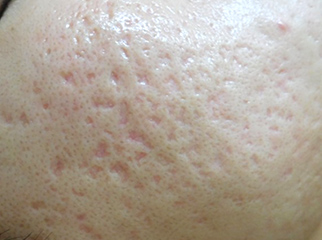 プラズマ治療(全顔・頬通常+ハイパワー) 治療前