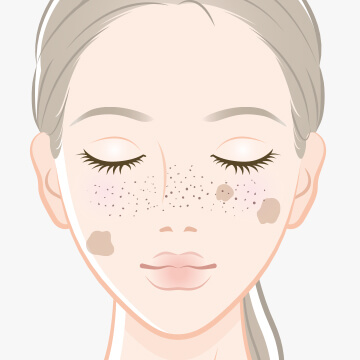 日光黒子(老人性色素班)・そばかす