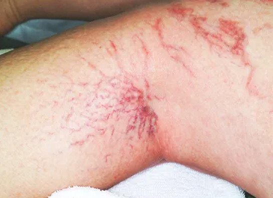 赤いしみ、赤ら顔、鼻の血管治療(毛細血管拡張症)