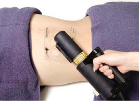 エキシマライトVTRAC白斑改善