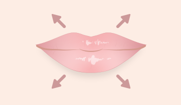 ふっくらしたボリューム感を出したい(ヒアルロン酸注入)