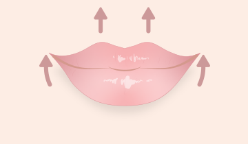 アヒル口にしたい(ヒアルロン酸注入)