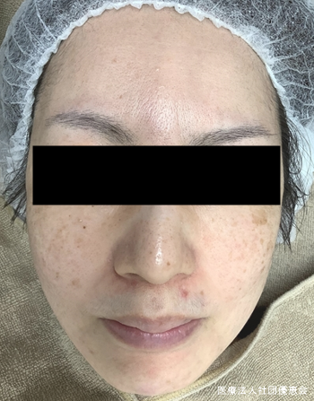 BBL+イオン導入 10回 施術前