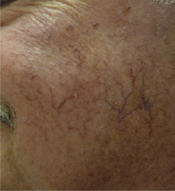 BBL光治療 コンプリートバージョン:BBL560nm 2パス 治療前