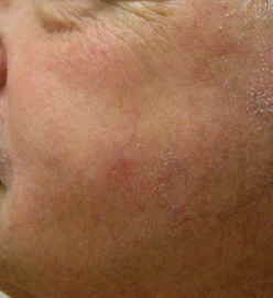 BBL光治療 コンプリートバージョン:BBL560nm 2パス 3回目治療後1か月